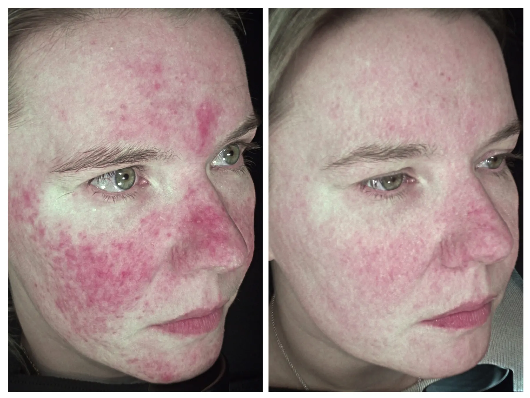 Rosacea before and after treatment