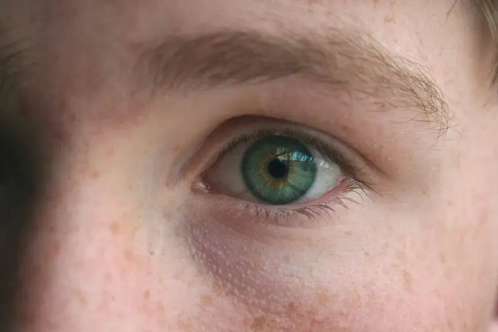 Close-up of a face showing brown pigmentation spots on the cheek