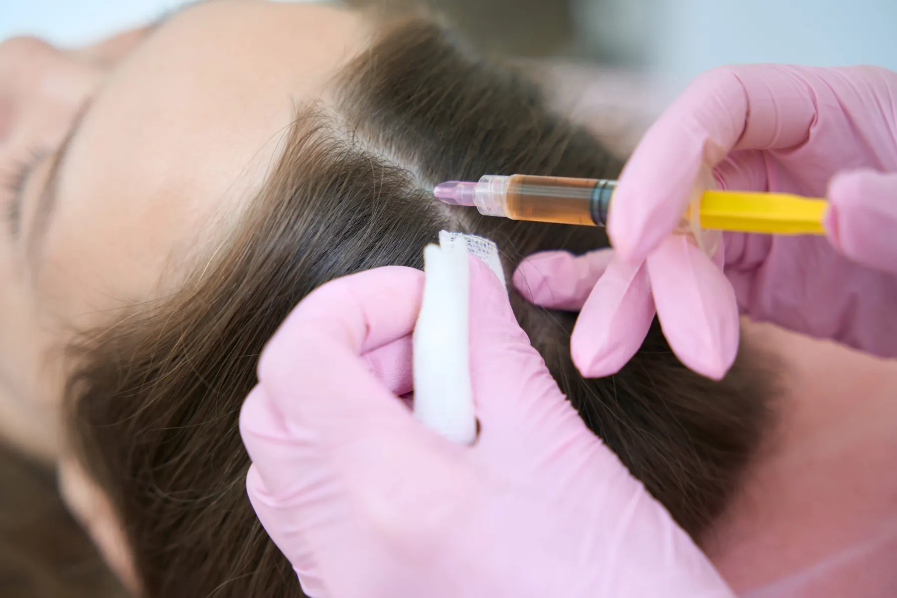 A clinician injecting platelet-rich plasma into a client's scalp