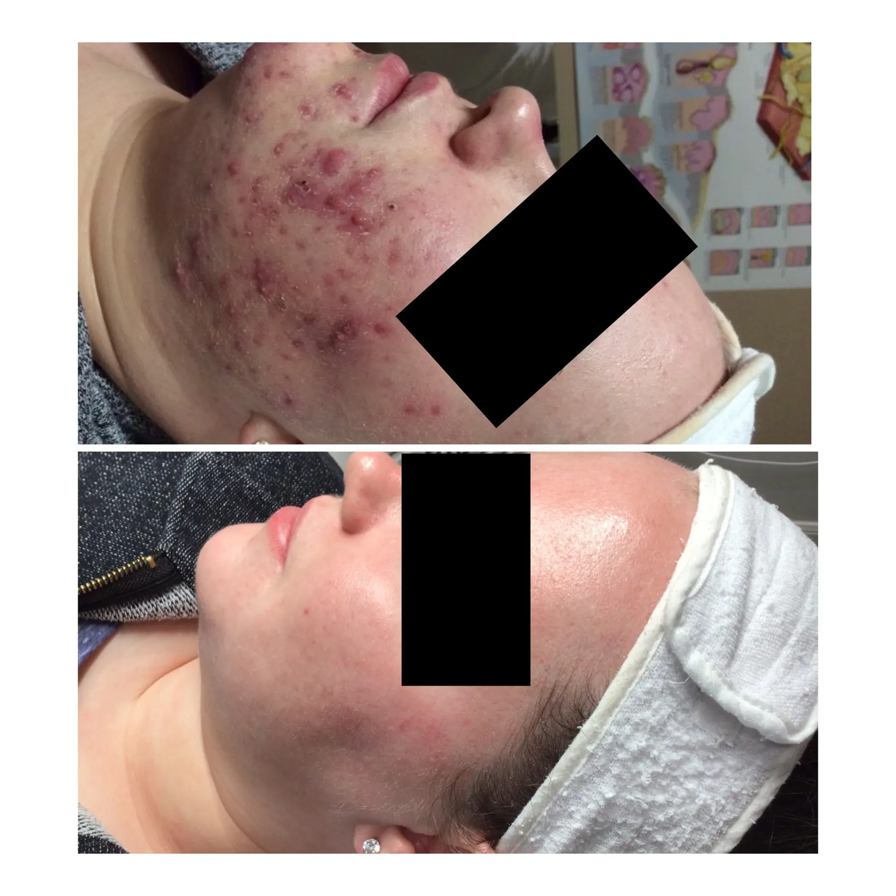 Patient photograph: inflamed cystic acne on the cheek, and the same cheek cleared after treatment. Privacy bar applied.