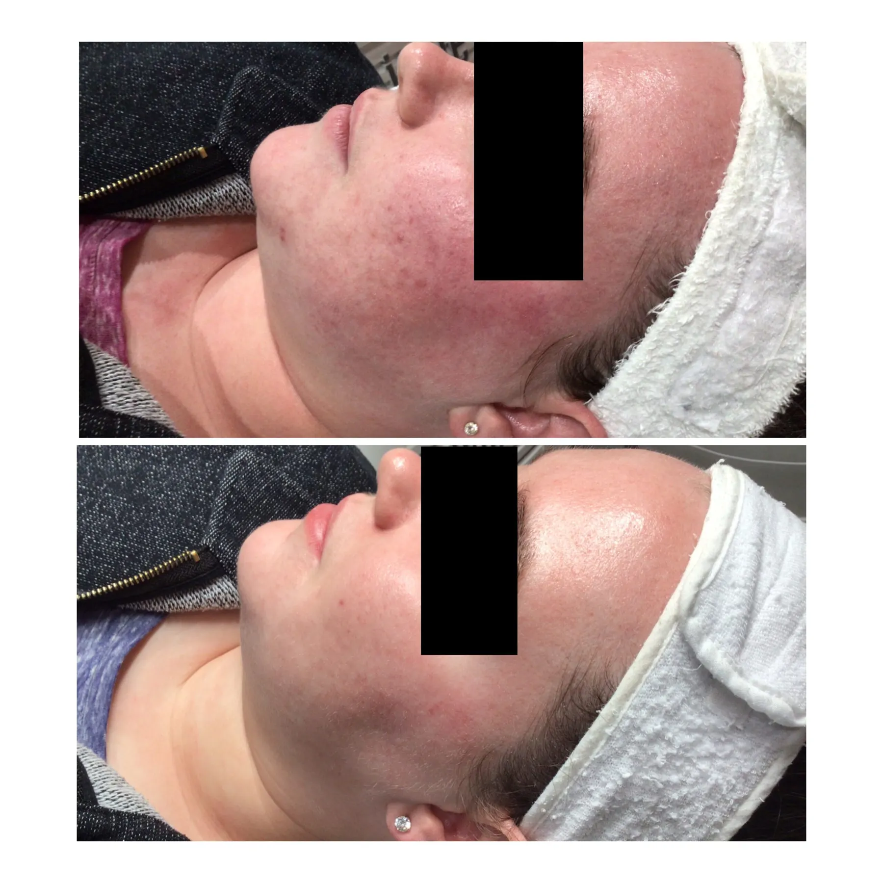 Patient photograph: facial redness and congestion before and after treatment. Privacy bar applied.