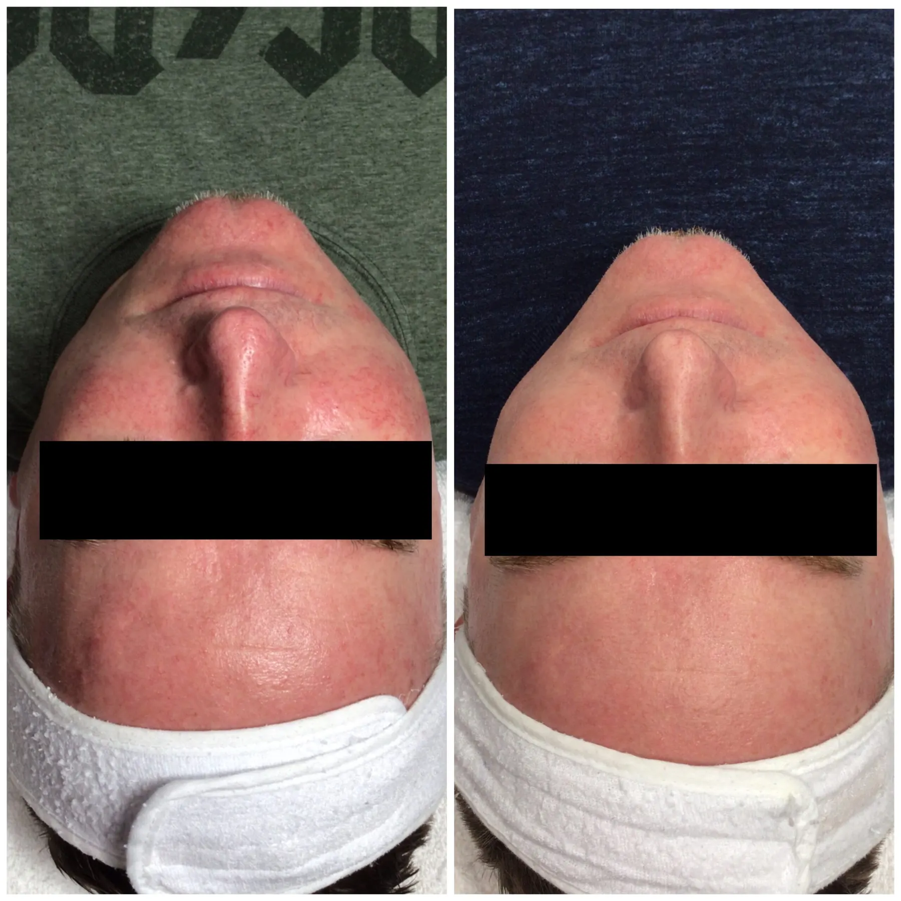 Patient photograph: rosacea flushing across the nose and cheeks before and after treatment. Privacy bar applied.