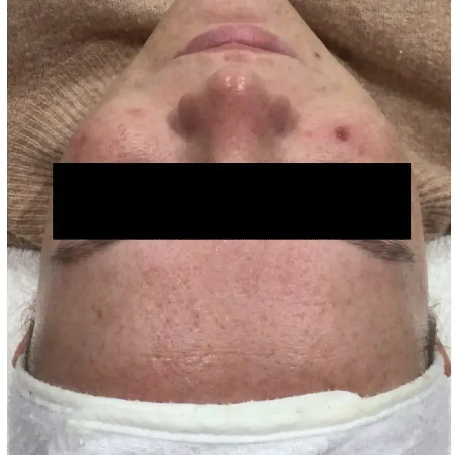 Client's nose and cheeks before treatment, showing pigmented lesions