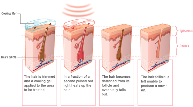 Laser Hair Removal