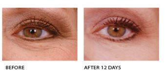 youth eye complex