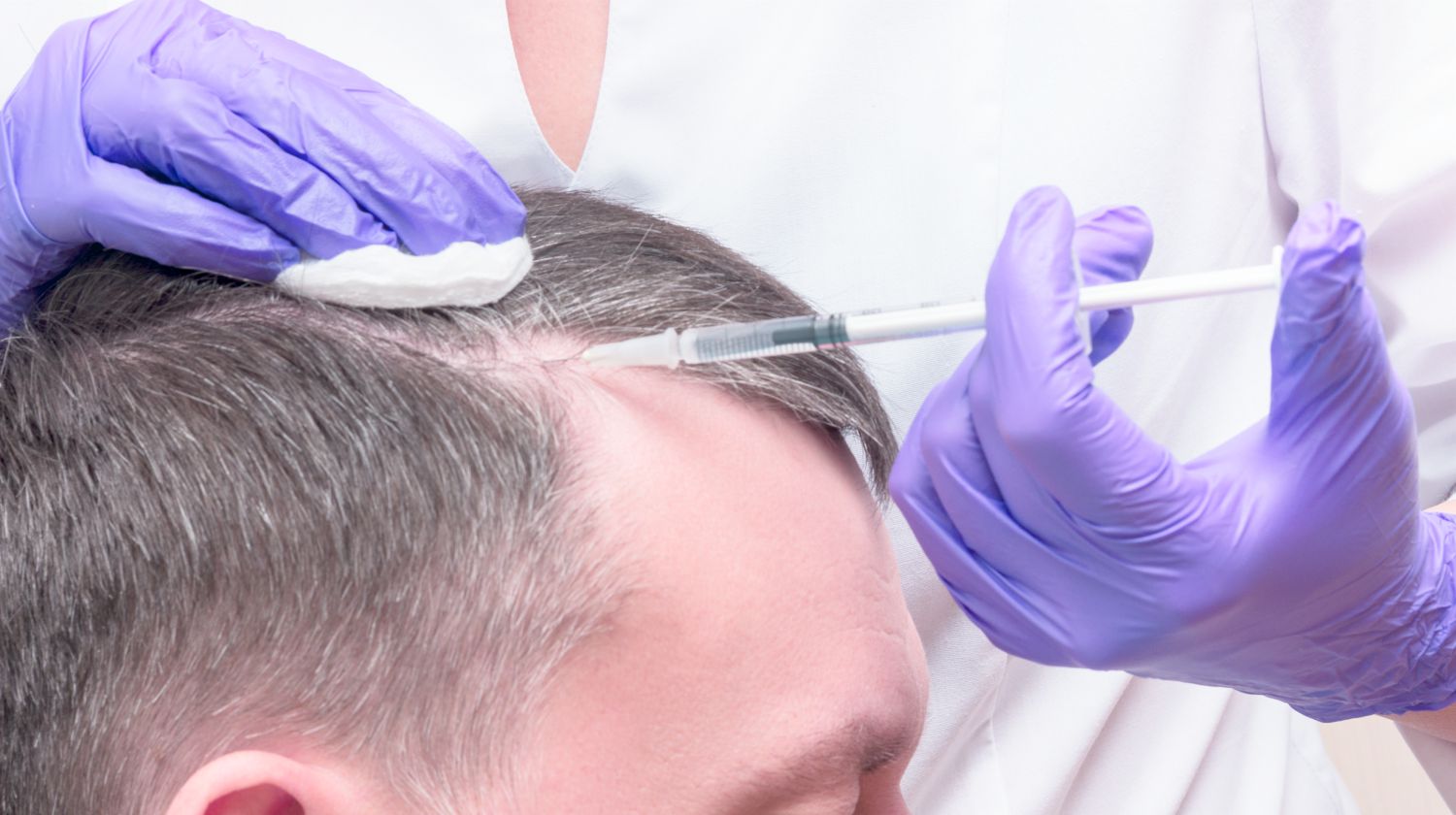 PRP for Hair Loss - Bradford Skin Clinic and Medical Spa