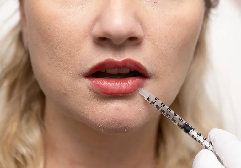 Dermal Fillers