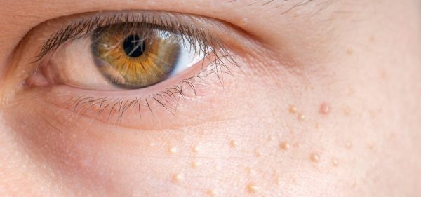 Milia Treatment