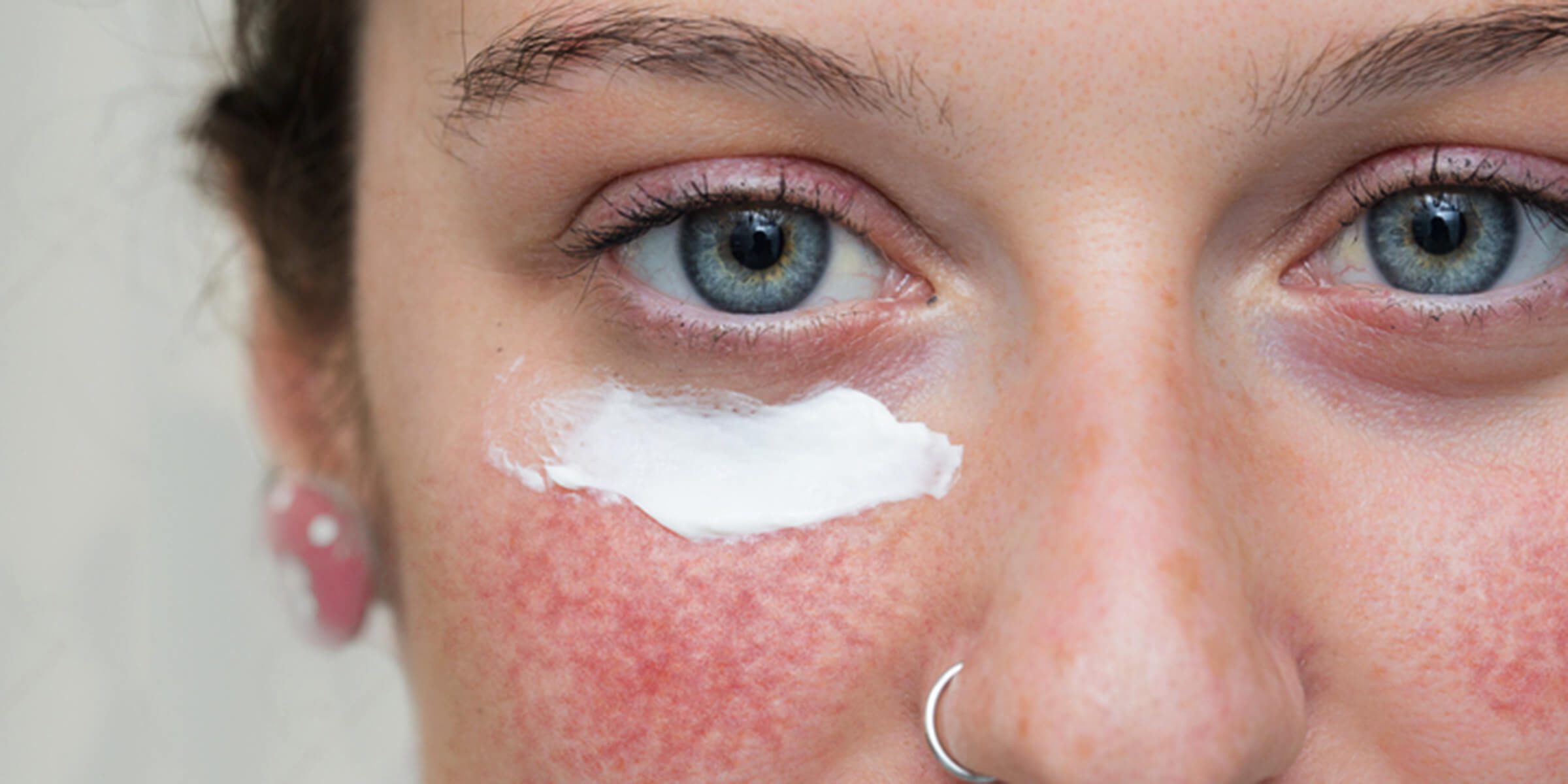 What is Rosacea? Bradford Skin Clinic and Medical Spa