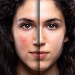 Rosacea Treatment