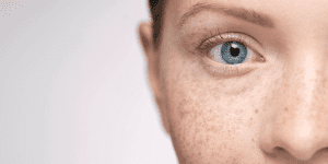 Pigmentation