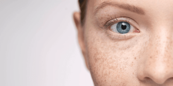 Pigmentation
