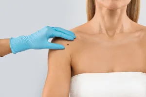 Mole Check